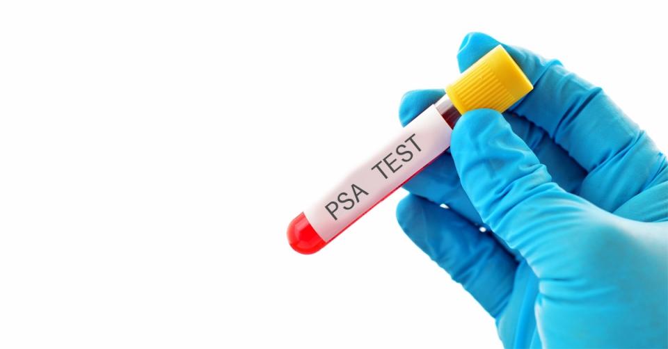 PSA prostate cancer test not fit for purpose image 