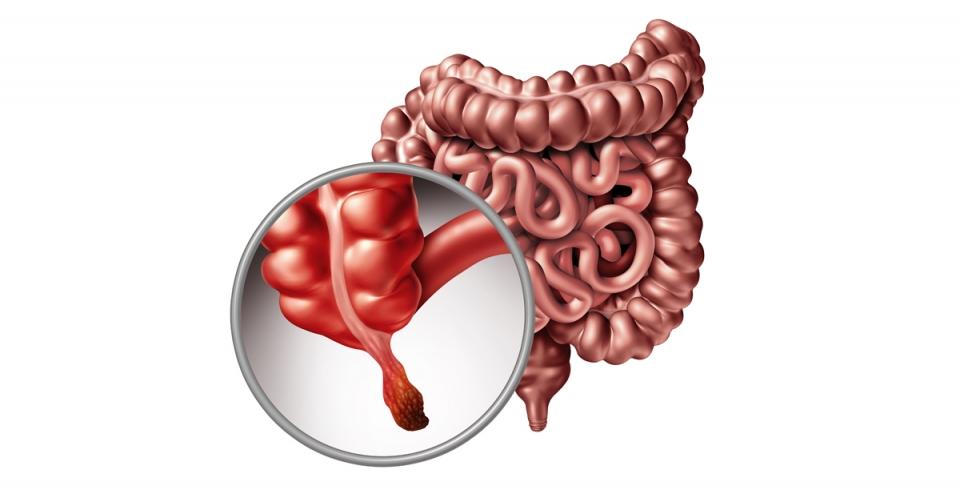 Having your appendix removed increases Parkinson's risk image 